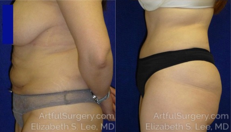 Picture of Tummy Tuck-11A