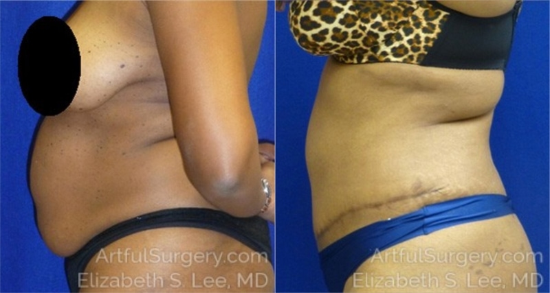 Picture of Tummy Tuck-12A