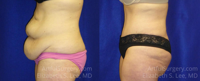 Picture of Tummy Tuck-13A