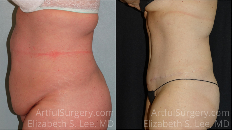 Picture of Tummy Tuck-14A
