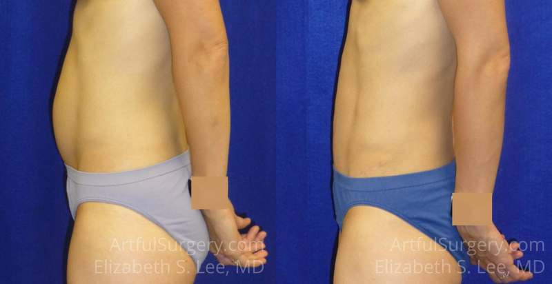 Picture of Tummy Tuck-15A