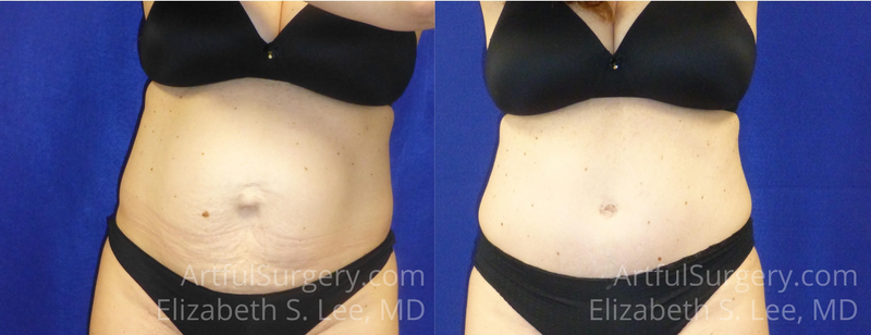 Picture of Tummy Tuck-16