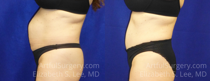 Picture of Tummy Tuck-16A