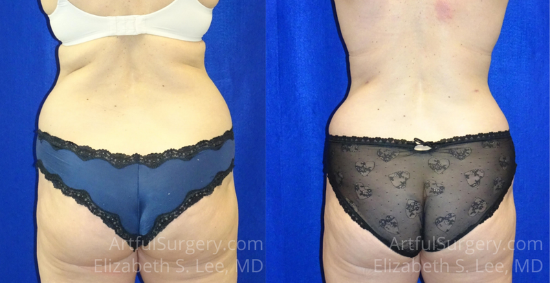 Picture of Tummy Tuck-17A
