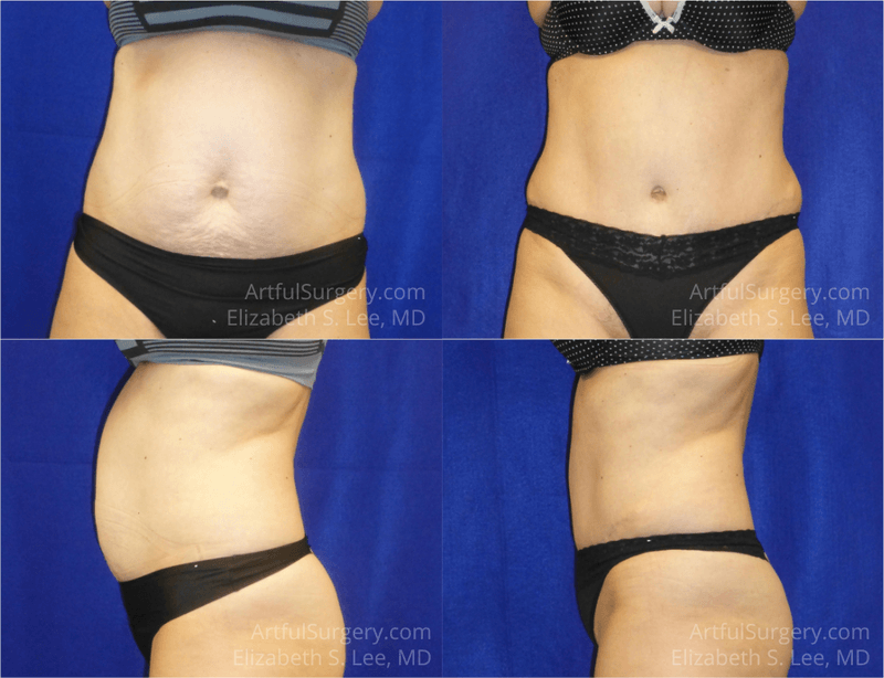 Picture of Tummy Tuck-18