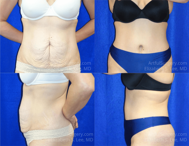 Picture of Tummy Tuck-19