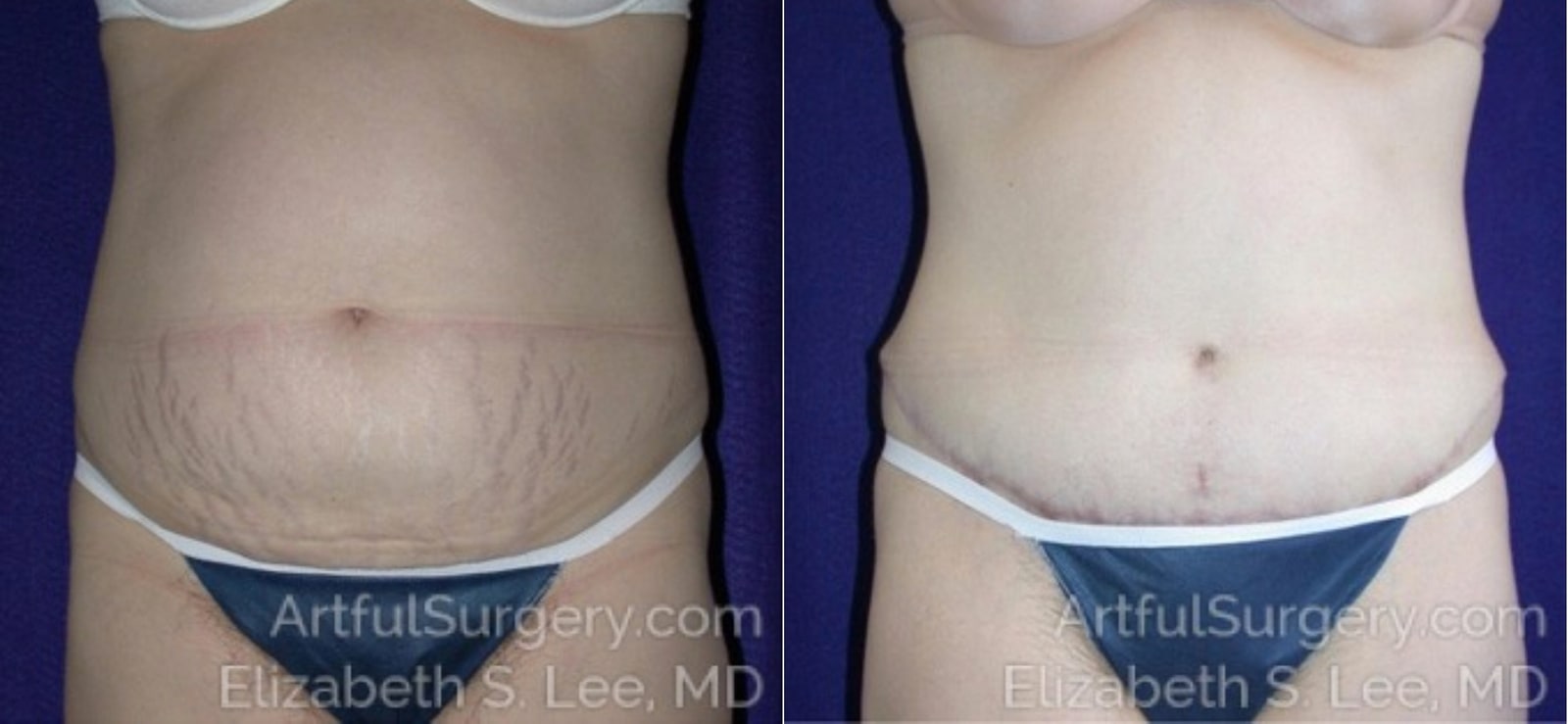 Picture of Tummy Tuck-02