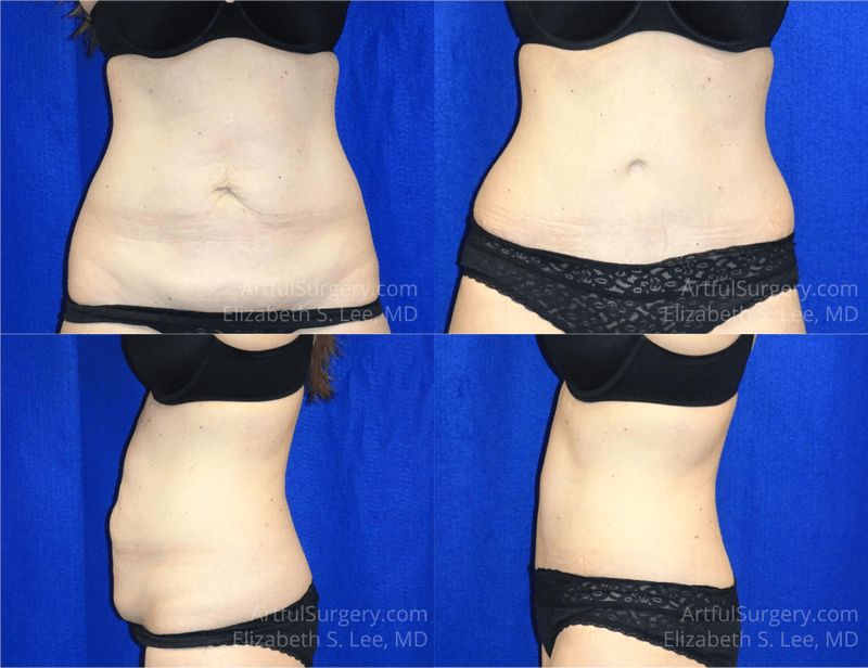 Picture of Tummy Tuck-20