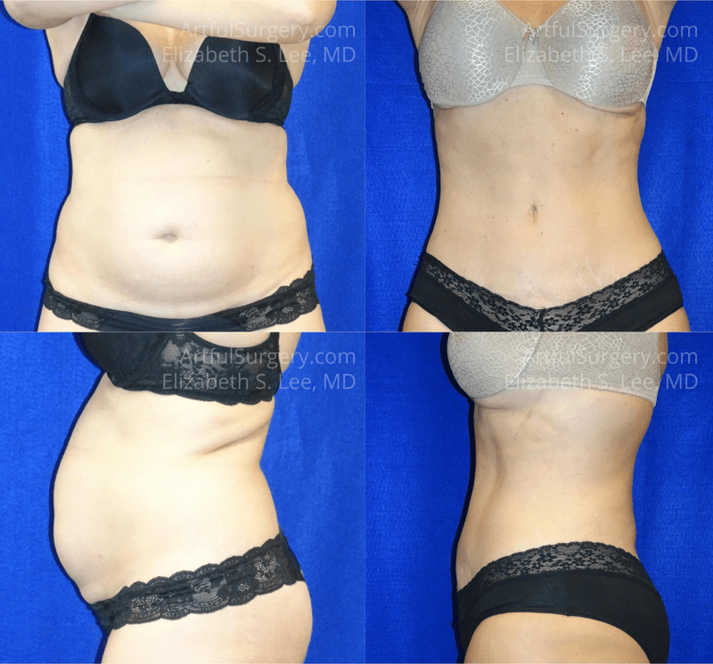 Picture of Tummy Tuck-21