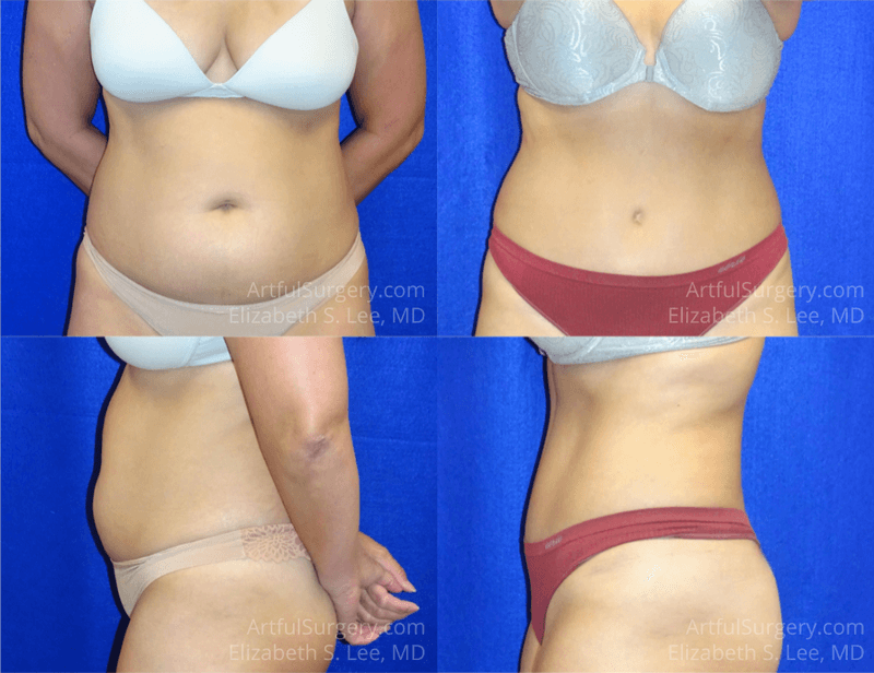 Picture of Tummy Tuck-22