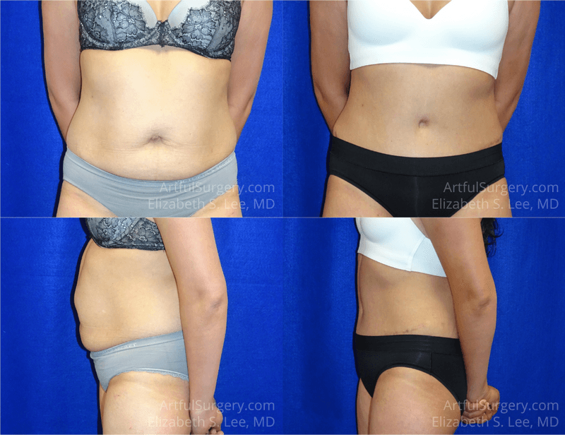 Picture of Tummy Tuck-23