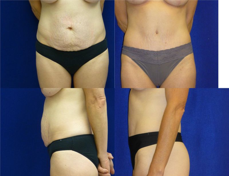 Picture of Tummy Tuck-24