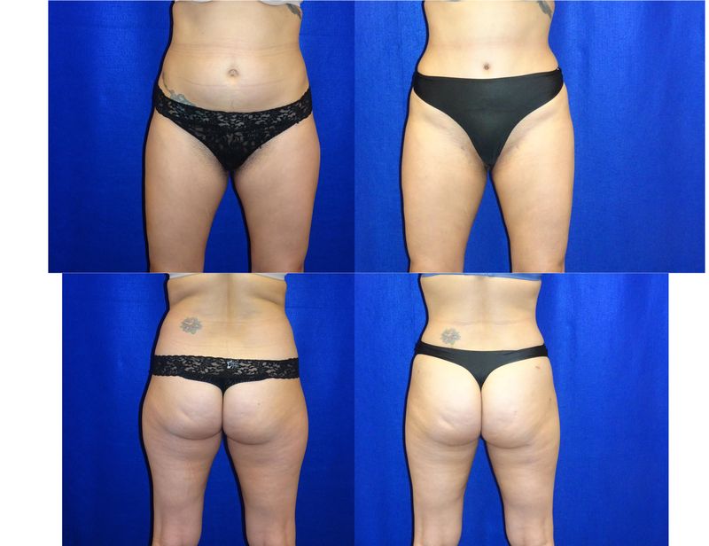 Picture of Tummy Tuck-25