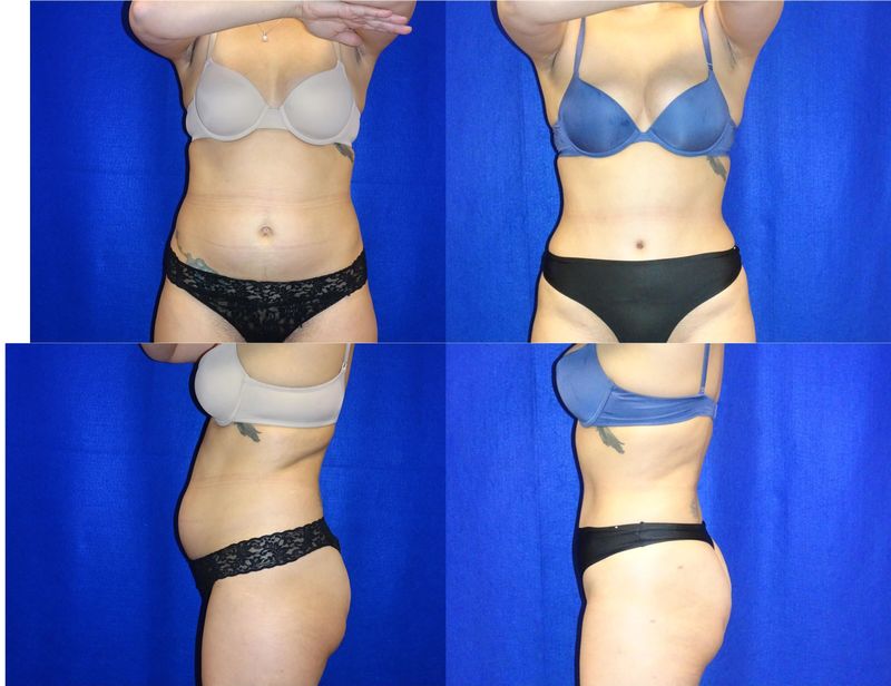 Picture of Tummy Tuck-25