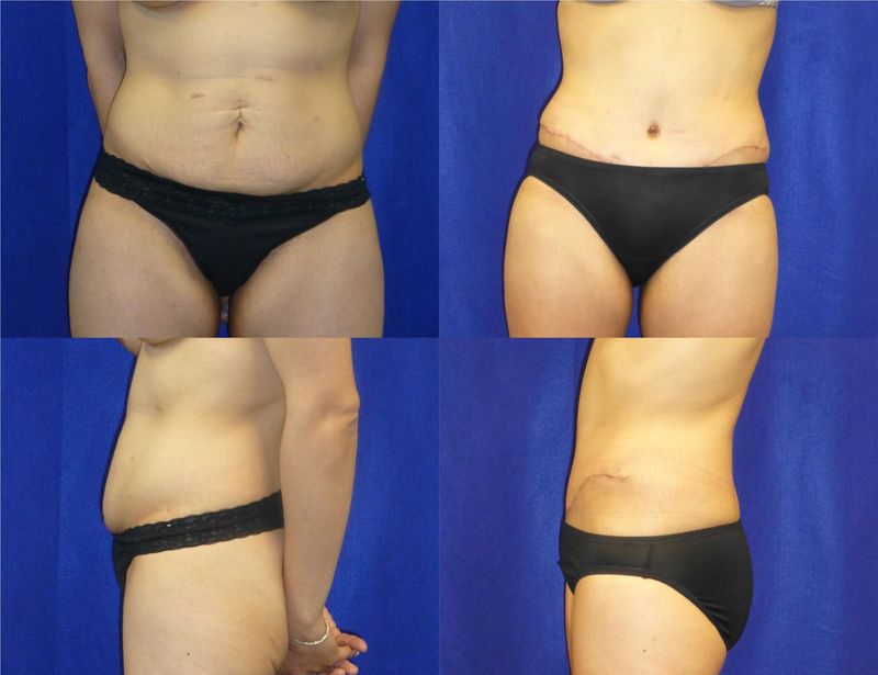 Picture of Tummy Tuck-28
