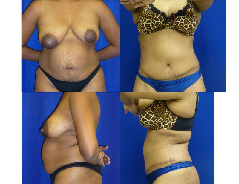 Picture of Tummy Tuck-29