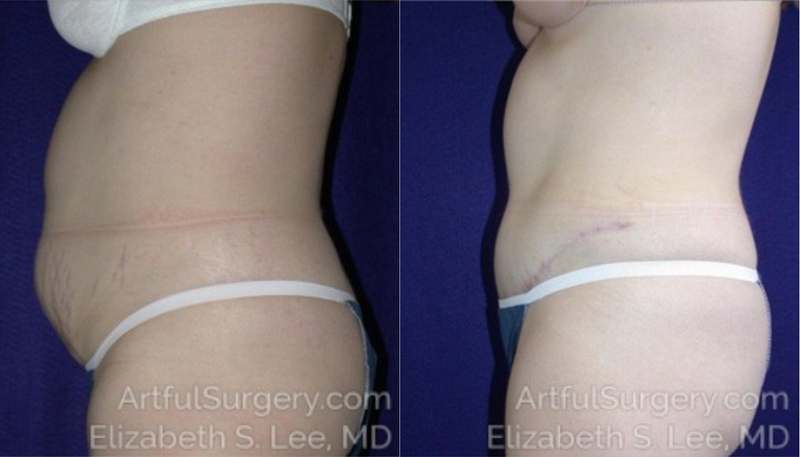 Picture of Tummy Tuck-02A