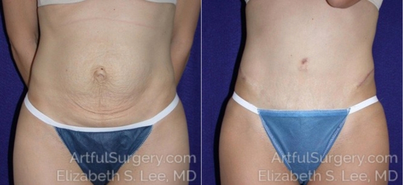Picture of Tummy Tuck-03