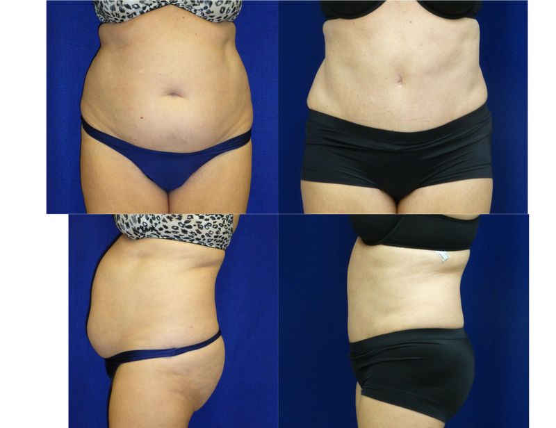 Picture of Tummy Tuck-30