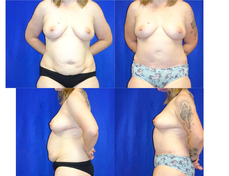 Picture of Tummy Tuck-32