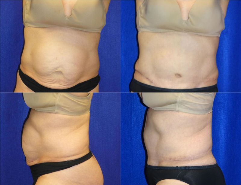 Picture of Tummy Tuck-34
