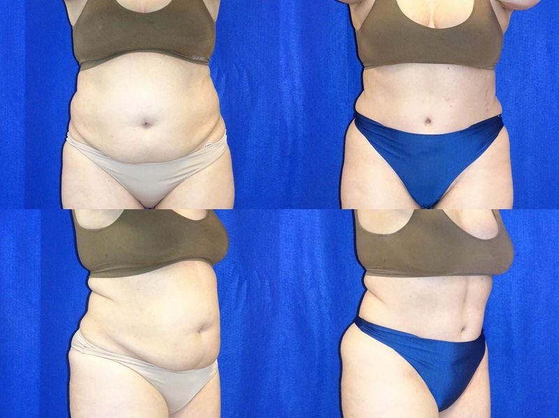 Picture of Tummy Tuck-35