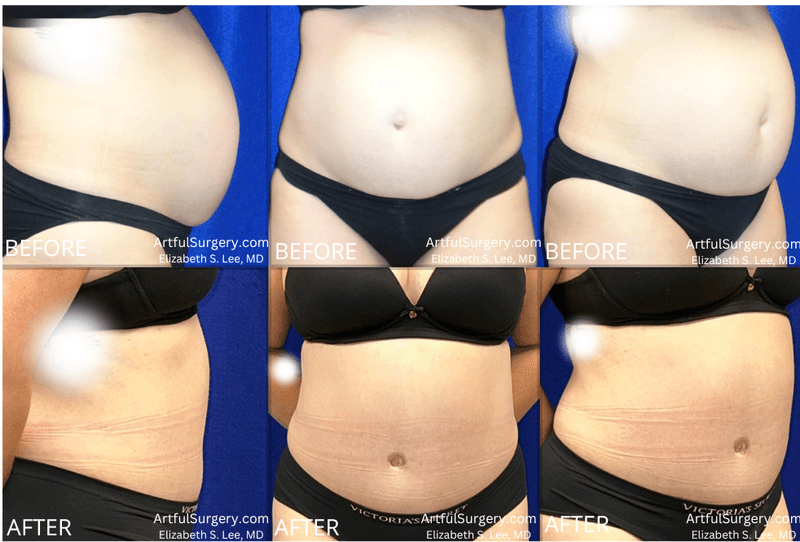 Picture of Tummy Tuck-36