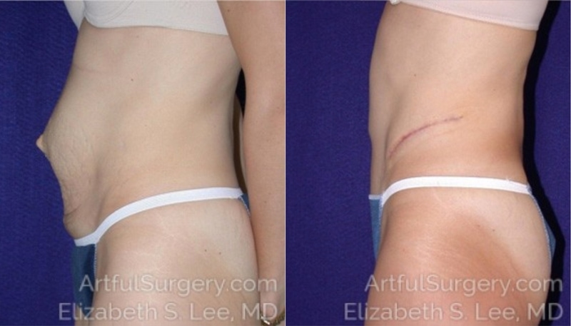 Picture of Tummy Tuck-03A