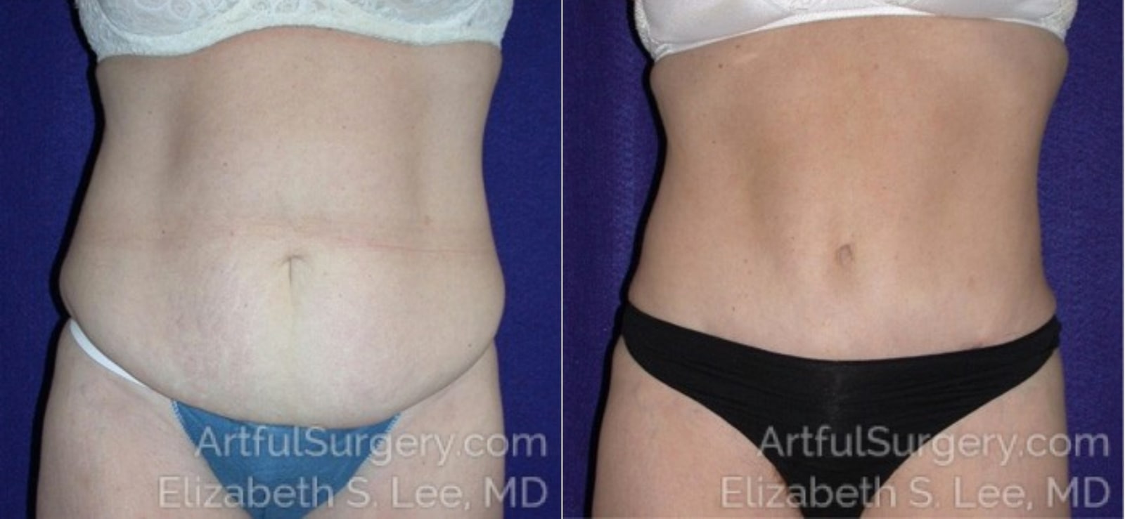 Picture of Tummy Tuck-04