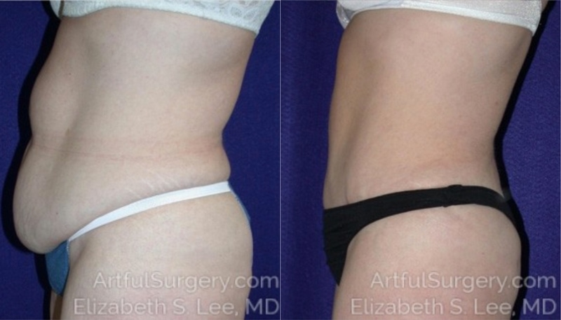 Picture of Tummy Tuck-04A