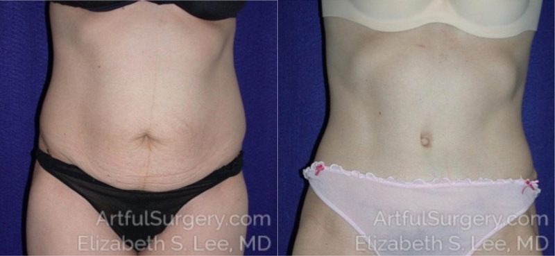 Picture of Tummy Tuck-05