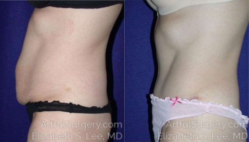 Picture of Tummy Tuck-05A