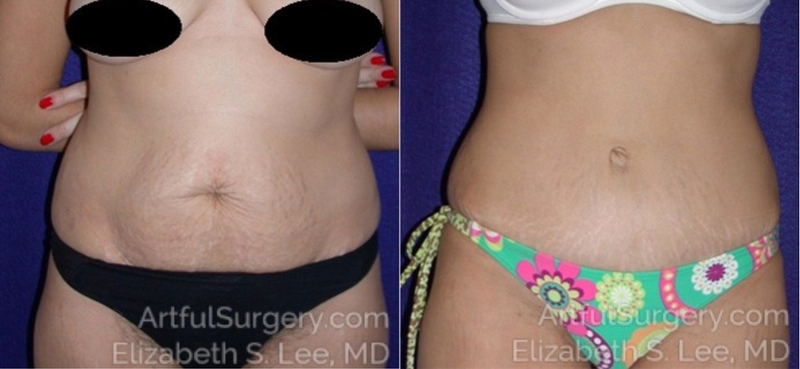 Picture of Tummy Tuck-06