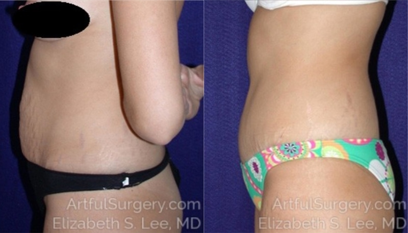 Picture of Tummy Tuck-06A