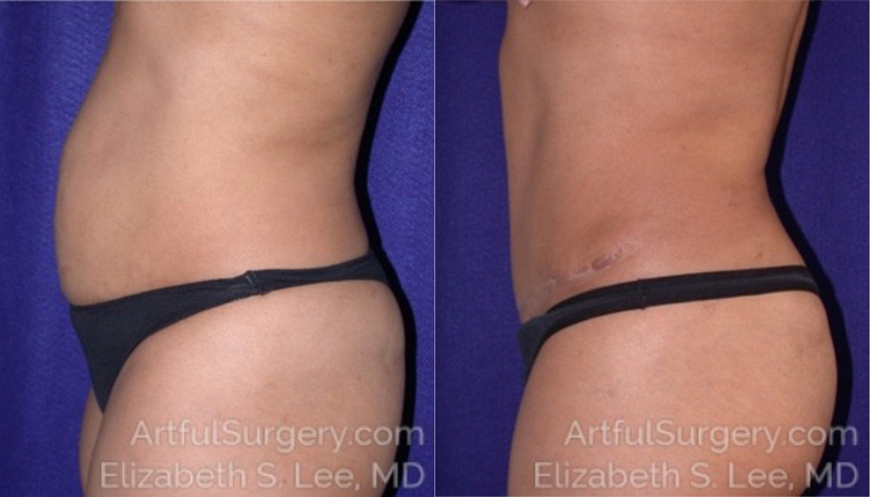 Picture of Tummy Tuck-07A
