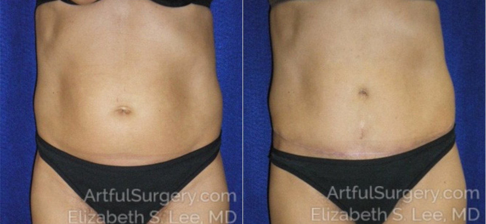 Picture of Tummy Tuck-08