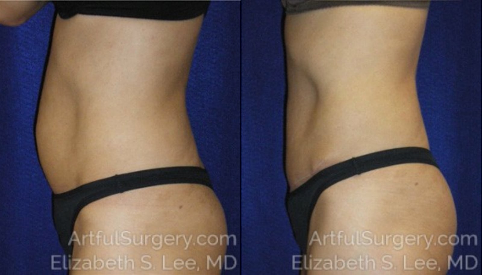 Picture of Tummy Tuck-08A