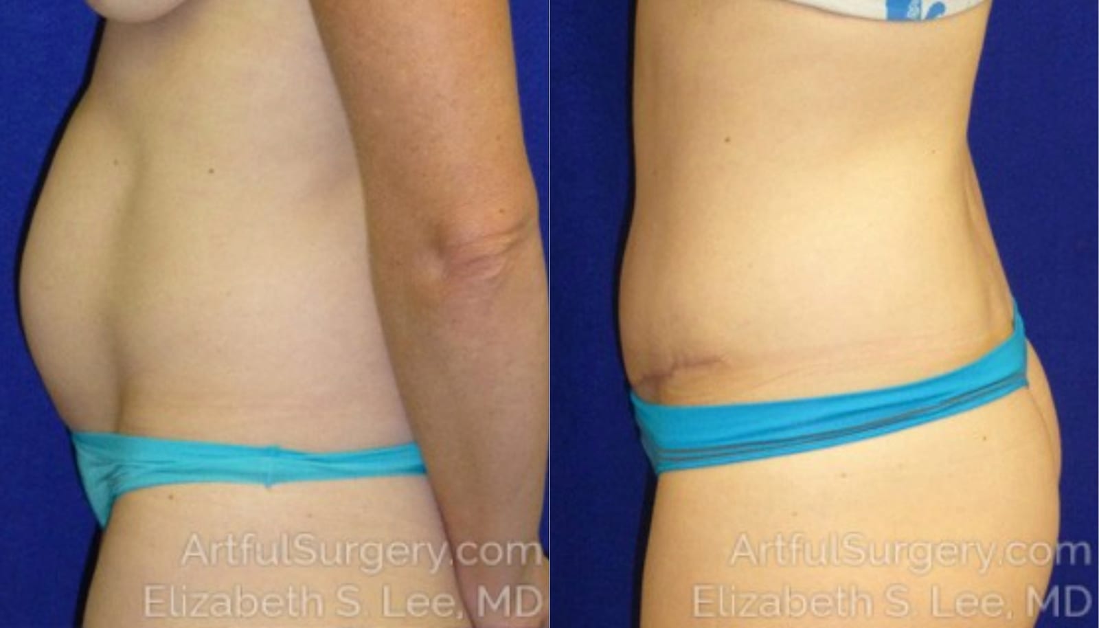 Picture of Tummy Tuck-09A