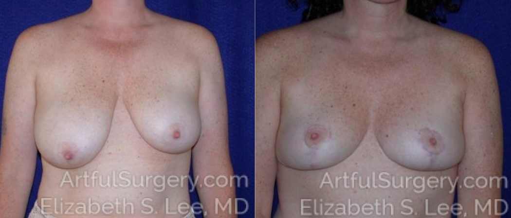 Picture of Asymmetric Breast Surgery 1