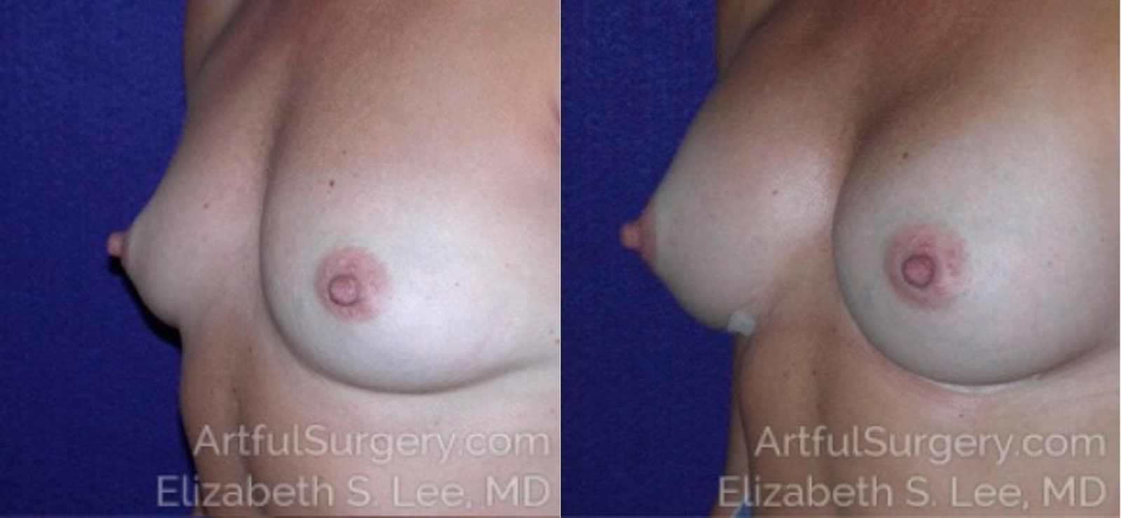 Picture of Breast Augmentation-10a