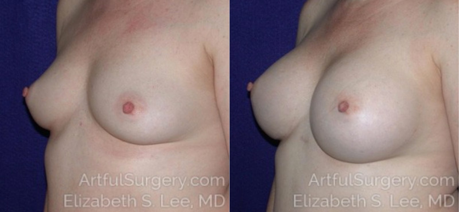 Picture of Breast Augmentation-11a