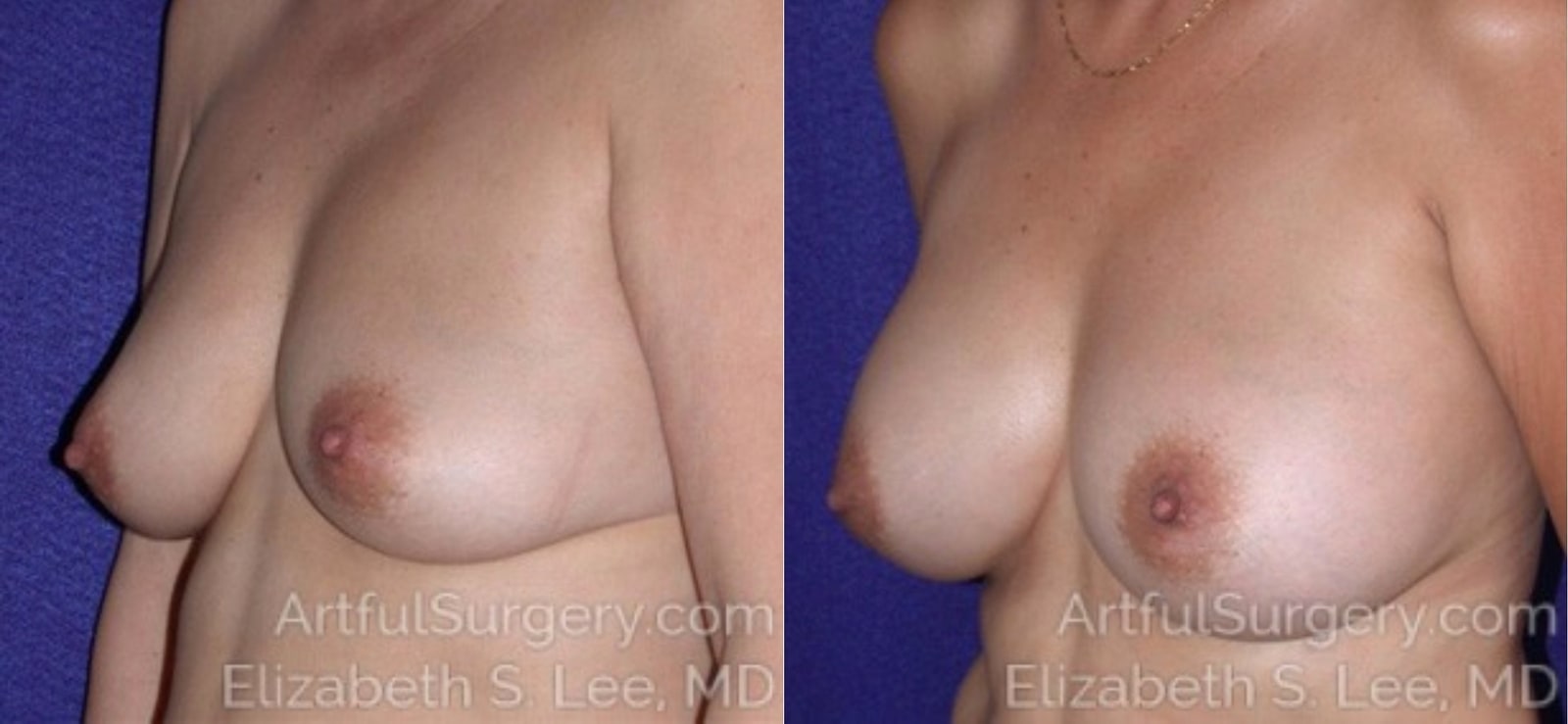 Picture of Breast Augmentation-12a