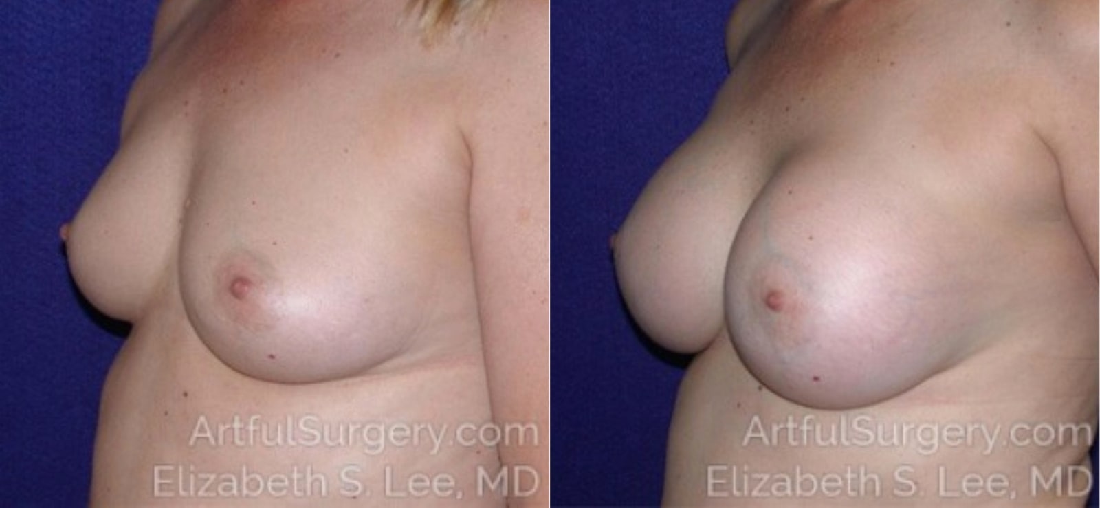 Picture of Breast Augmentation-13a