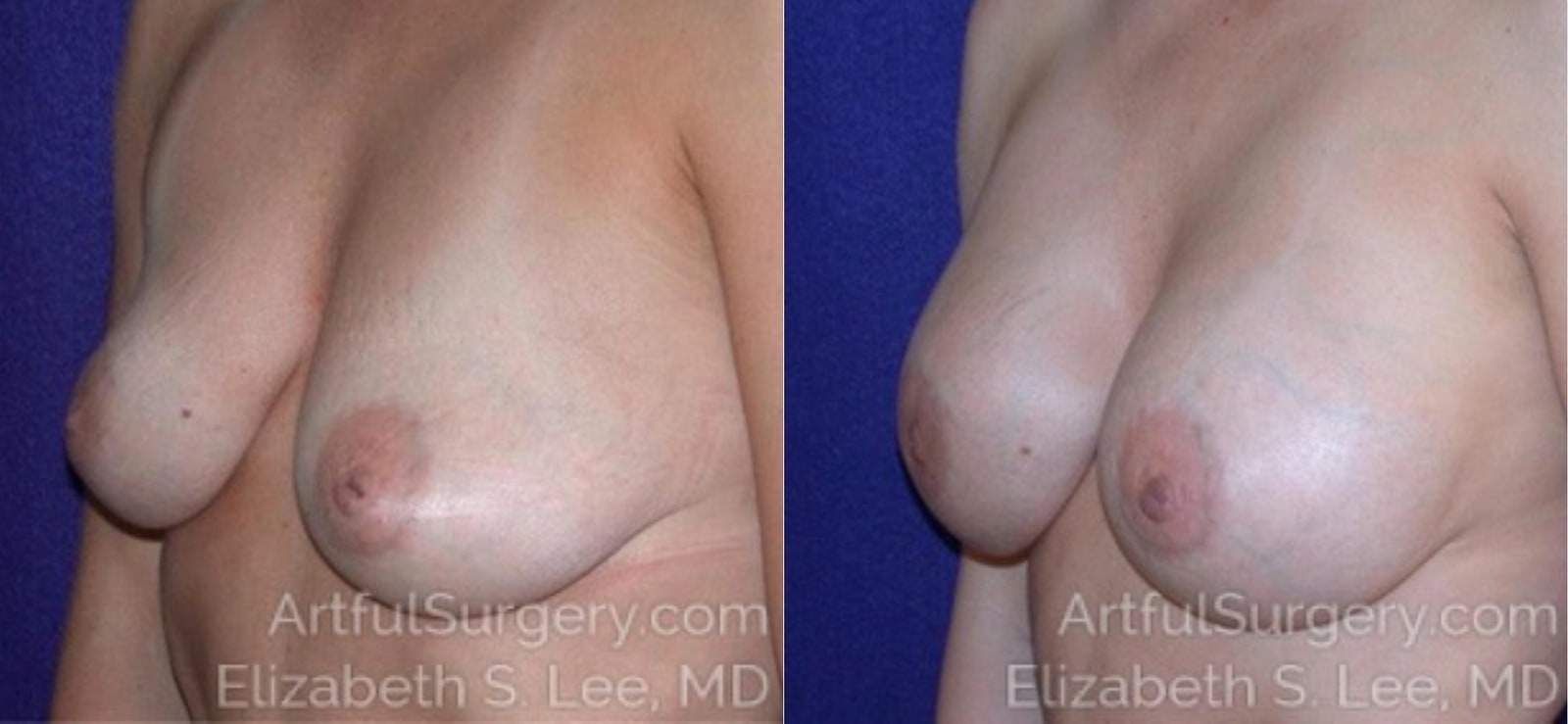 Picture of Breast Augmentation-14a