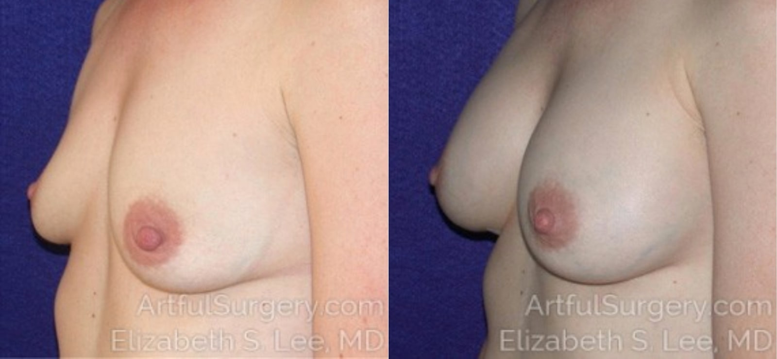 Picture of Breast Augmentation-15