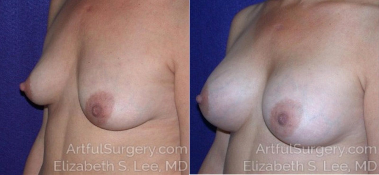 Picture of Breast Augmentation-16a