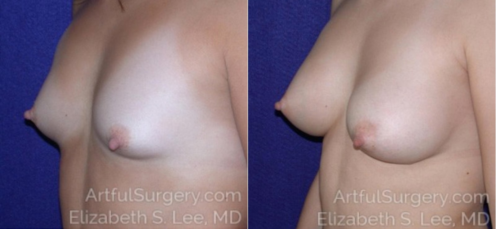 Picture of Breast Augmentation-17a