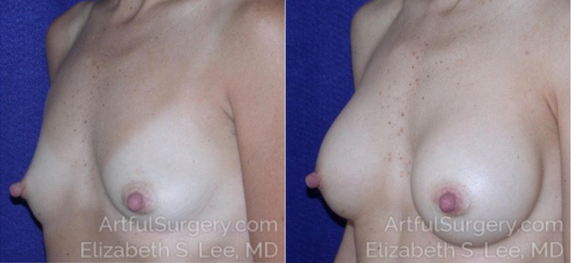 Picture of Breast Augmentation-18a