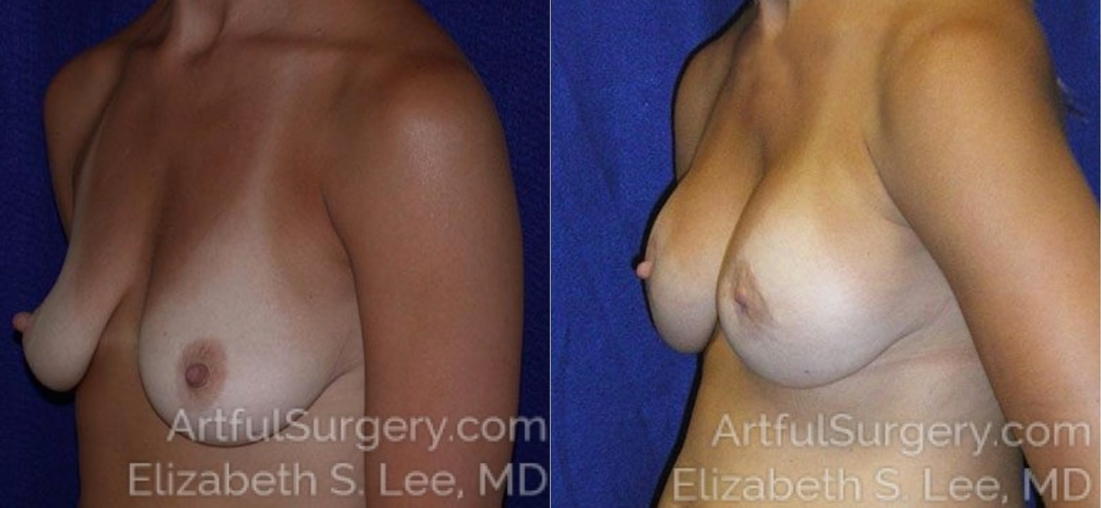 Picture of Breast Augmentation-1a