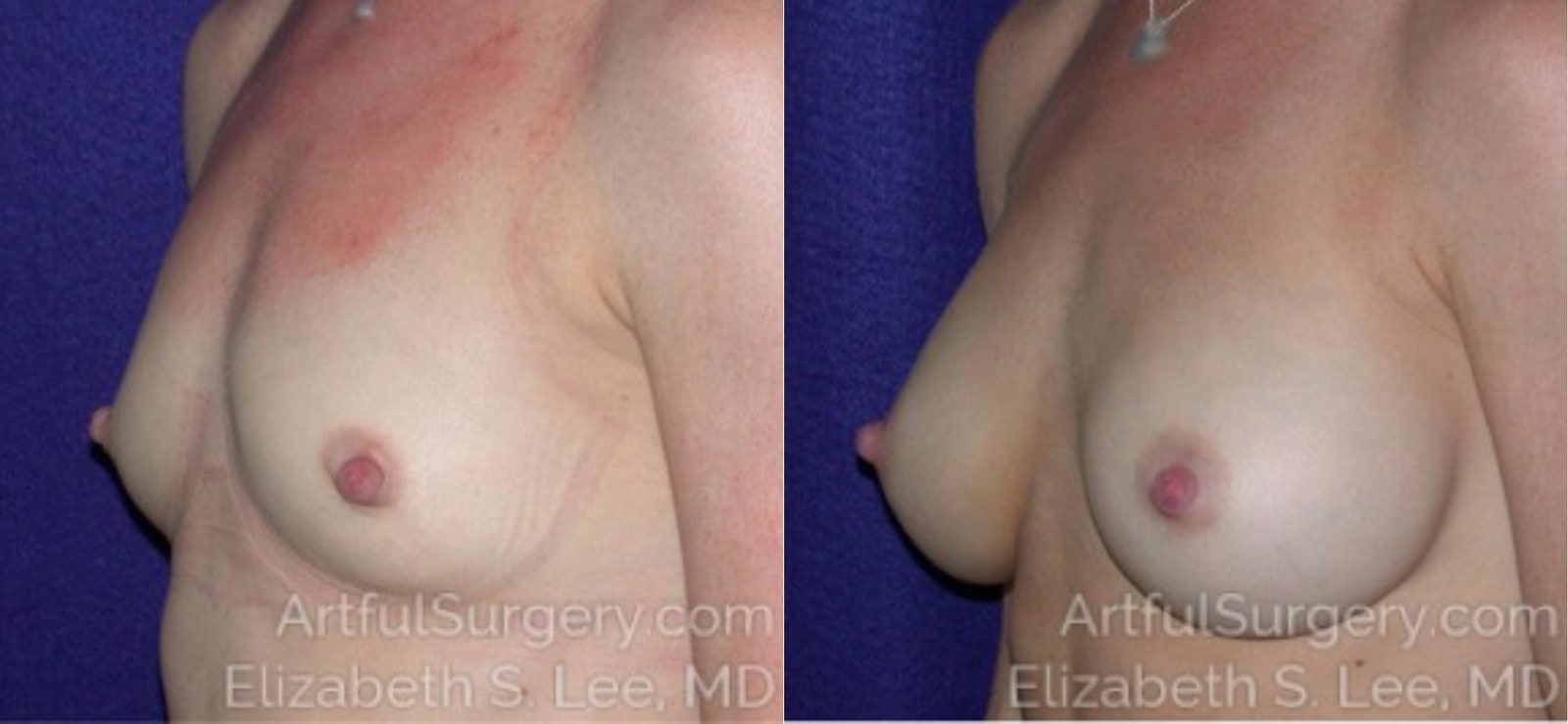 Picture of Breast Augmentation-20a
